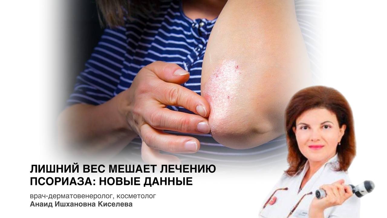 Лишний вес мешает лечению псориаза: новые данные